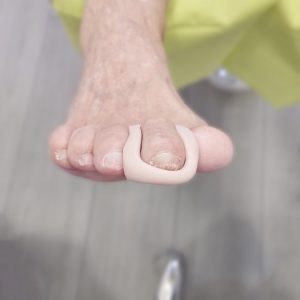 Pie con deformación en los dedos por amputación con una órtesis de silicona a medida, vista cenital